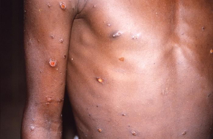 Az mpox miatt globális egészségügyi vészhelyzetet hirdet a WHO – 4 könyv járványokról